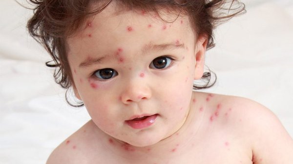 Chăm sóc trẻ bị thủy đậu đúng cách tránh các biến chứng nguy hiểm | Vinmec
