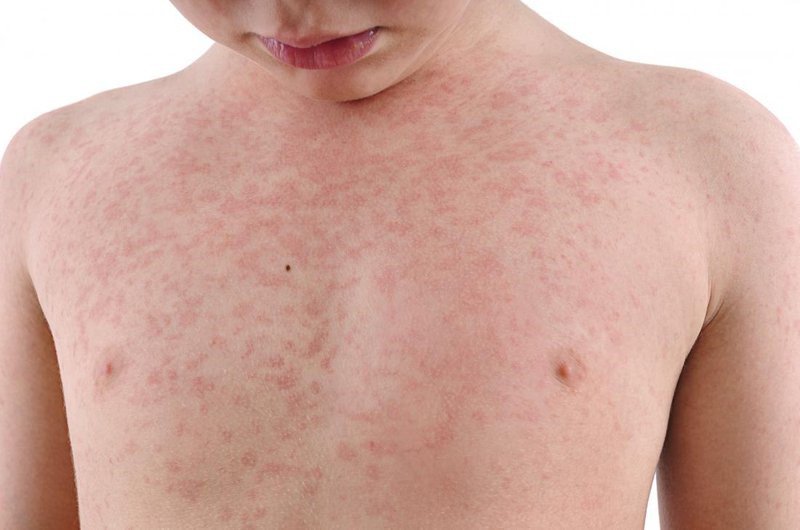 Rubella (bệnh sởi Đức) khác sởi thông thường như thế nào? | Vinmec