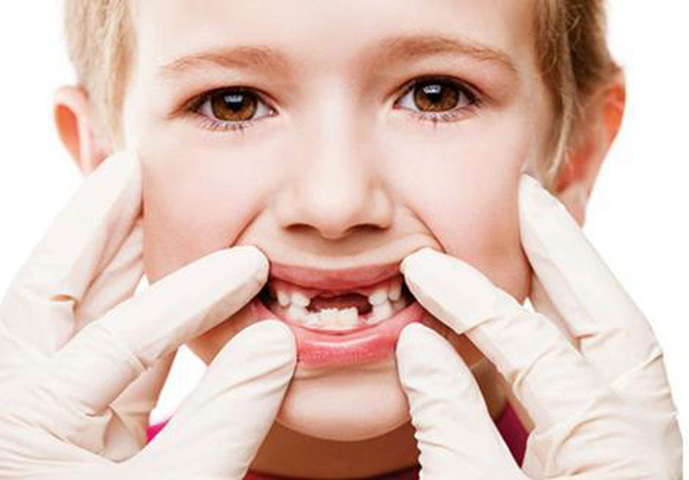 Sâu răng ở trẻ em: Nguyên nhân, dấu hiệu nhận biết lúc mới chớm | Vinmec