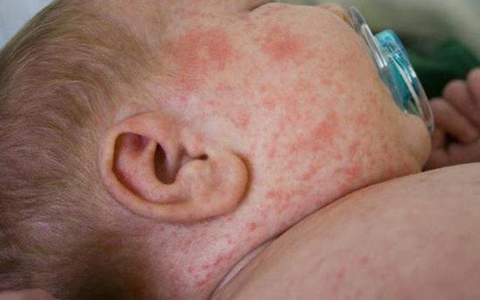 Nhận diện sốt xuất huyết ở trẻ dưới 1 tuổi | Vinmec