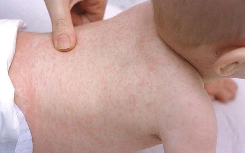 Hỏi đáp: Sốt phát ban có nguy hiểm không? | Medlatec