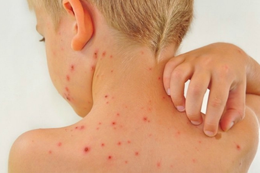 Các Triệu Chứng Bệnh Rubella Và Cách Chăm Sóc Người Bệnh