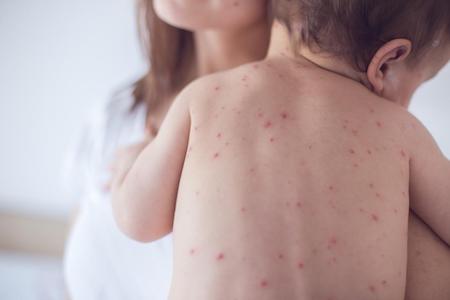 Những dấu hiệu phân biệt sởi và phát ban ở trẻ nhỏ mà cha mẹ nên biết - Dizigone - Kháng khuẩn vượt trội