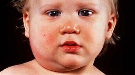 Bệnh quai bị ở trẻ em (P1): Nguyên nhân và triệu chứng bệnh quai bị - KidsOnline