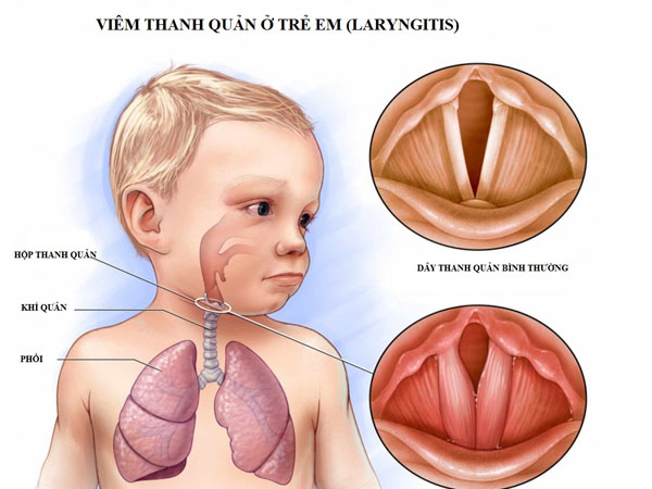 Viêm thanh quản ở trẻ em: Nguyên nhân và cách điều trị
