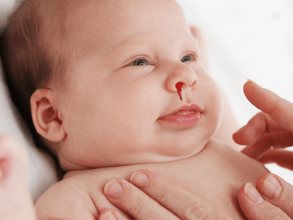 Chảy máu cam vì ngồi điều hòa nhiều